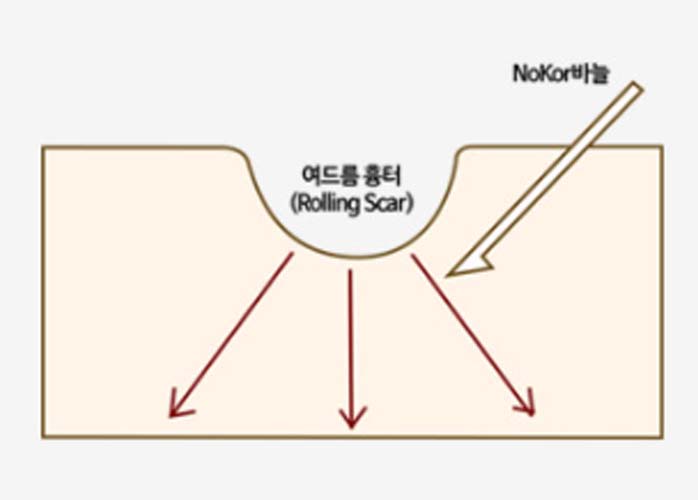 서브시전 